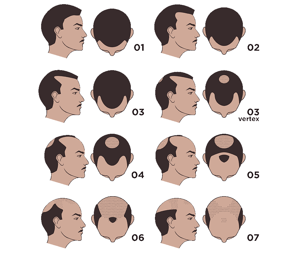 hairloss